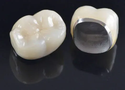Porcelain-fused-to-metal (PFM) crowns