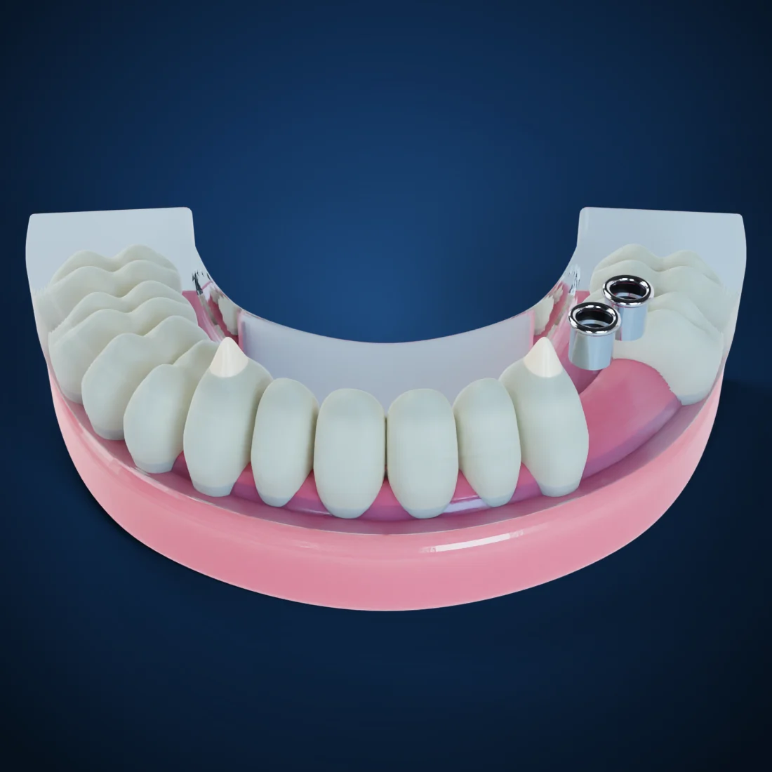 Surgical guides (3D render)