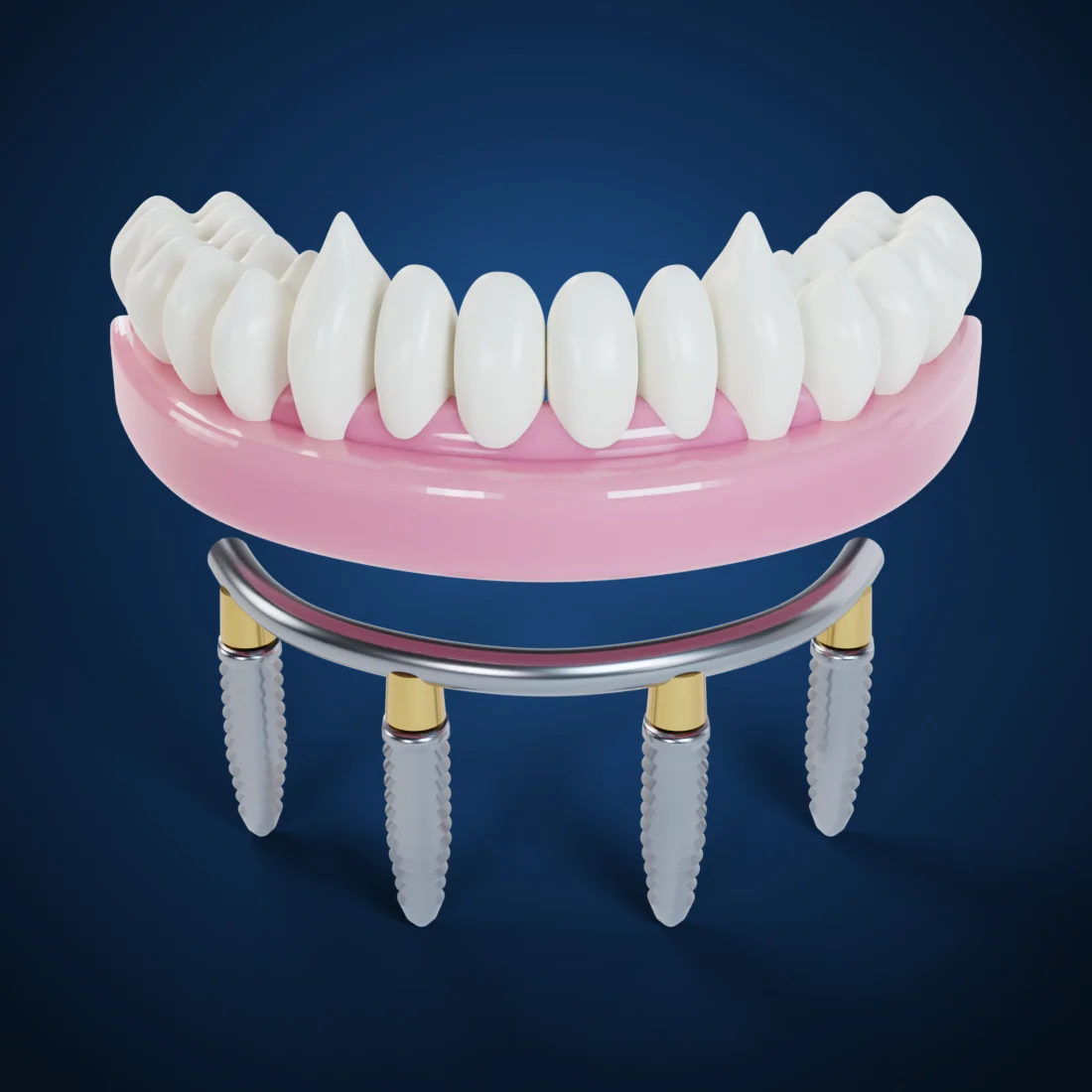 Zirconia restorations on implant bars (3D render)