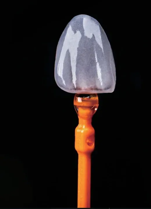 E.max veneers